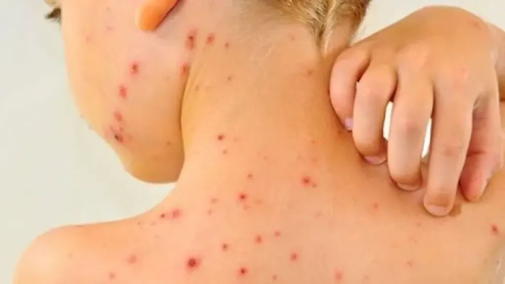 ظهور حالات جديري الماء بين طلاب مدرسة في محافظة المنوفية.. الأعراض وطرق العلاج