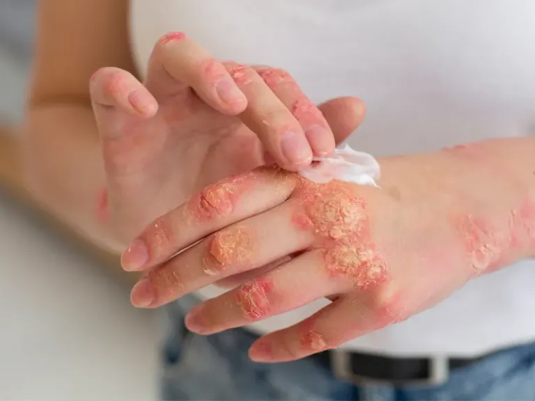 الصدفية.. 6 خرافات شائعة حول مرض جلدي يثير الوصم الاجتماعي الصدفية.. 6 خرافات شائعة حول مرض جلدي يثير الوصم الاجتماعي